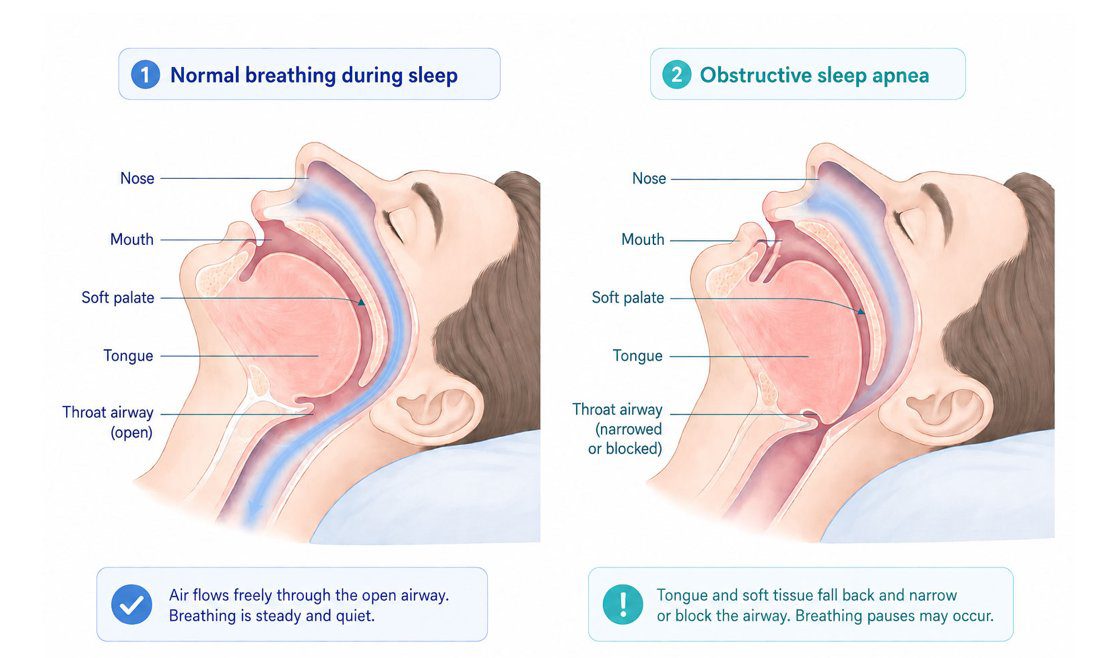 Normal vs. obstructive sleep apnea illustration
